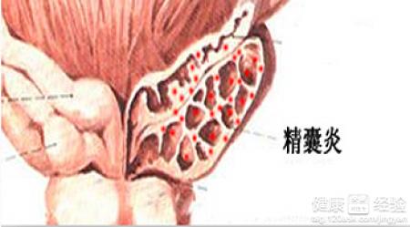 精囊炎金方苗药大健康养生精囊炎什么症状什么原因如何食疗治疗