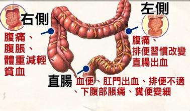 结肠癌是什么症状如何食疗治疗苗药健康养生