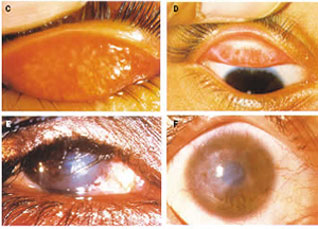 trachoma)是由沙眼衣原体(chlamydia)引起的一种慢性传染性结膜角膜炎