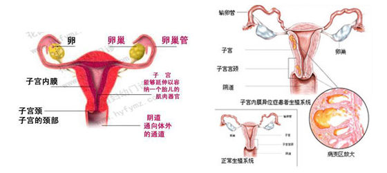 子宫内膜异位概述以及原因和症状金方苗家养生集团子宫内膜异位容易